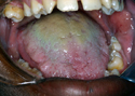 Hairy Tongue